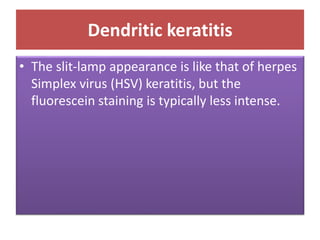 Dendritic keratitis
• The slit-lamp appearance is like that of herpes
Simplex virus (HSV) keratitis, but the
fluorescein staining is typically less intense.
 