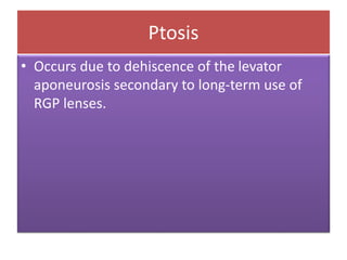 Ptosis
• Occurs due to dehiscence of the levator
aponeurosis secondary to long-term use of
RGP lenses.
 