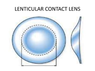 LENTICULAR CONTACT LENS
 