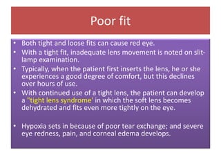 Poor fit
• Both tight and loose fits can cause red eye.
• With a tight fit, inadequate lens movement is noted on slit-
lamp examination.
• Typically, when the patient first inserts the lens, he or she
experiences a good degree of comfort, but this declines
over hours of use.
• With continued use of a tight lens, the patient can develop
a "tight lens syndrome' in which the soft lens becomes
dehydrated and fits even more tightly on the eye.
• Hypoxia sets in because of poor tear exchange; and severe
eye redness, pain, and corneal edema develops.
 