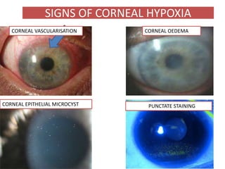 CORNEAL OEDEMACORNEAL VASCULARISATION
SIGNS OF CORNEAL HYPOXIA
CORNEAL EPITHELIAL MICROCYST PUNCTATE STAINING
 