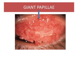 GIANT PAPILLAE
 
