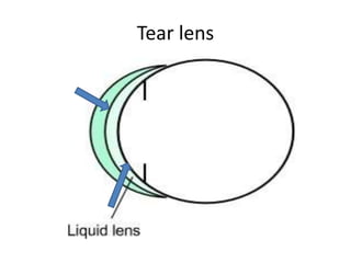 Tear lens
 