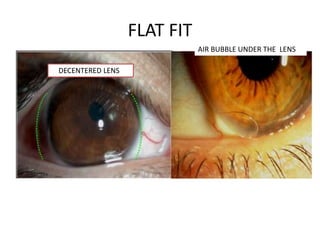FLAT FIT
DECENTERED LENS
AIR BUBBLE UNDER THE LENS
 