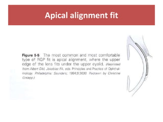 Apical alignment fit
 
