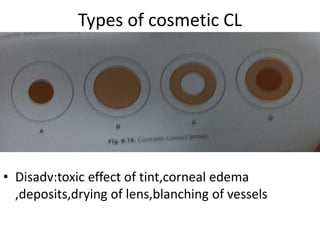 Types of cosmetic CL
• Disadv:toxic effect of tint,corneal edema
,deposits,drying of lens,blanching of vessels
 