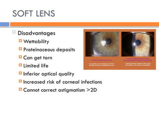 SOFT LENS
 Disadvantages
 Wettability
 Proteinaceous deposits
 Can get torn
 Limited life
 Inferior optical quality
 Increased risk of corneal infections
 Cannot correct astigmatism >2D
 