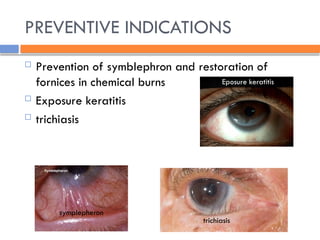 PREVENTIVE INDICATIONS
 Prevention of symblephron and restoration of
fornices in chemical burns
 Exposure keratitis
 trichiasis
Eposure keratitis
symplepheron
trichiasis
 
