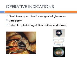 OPERATIVE INDICATIONS
 Goniotomy operation for congenital glaucoma
 Vitrectomy
 Endocular photocoagulation (retinal endo-laser)
 