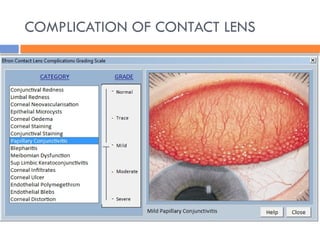 COMPLICATION OF CONTACT LENS
 