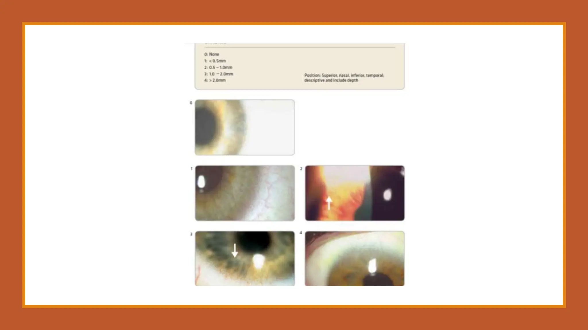 Soft & RGP Contact lens complications.pptx