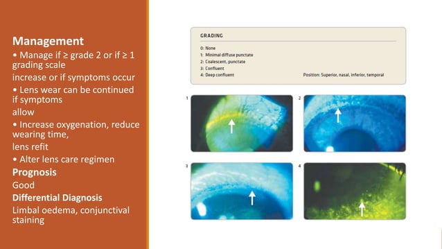 High Riding Rgp Soft & RGP Contact lens complications.pptx | Eye and Vision Conditions ...