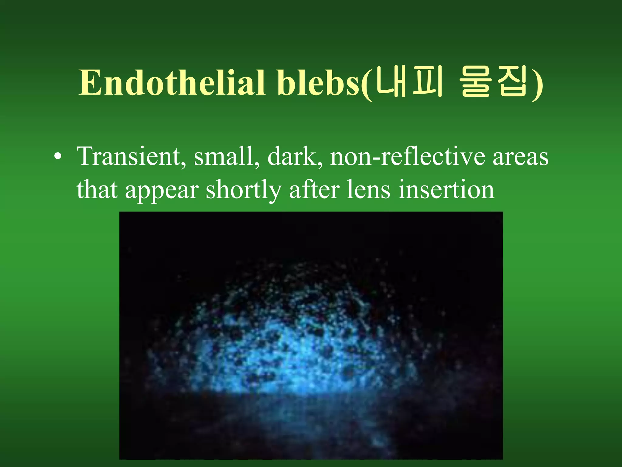 Endothelial blebs(내피 물집)
• Transient, small, dark, non-reflective areas
that appear shortly after lens insertion
 