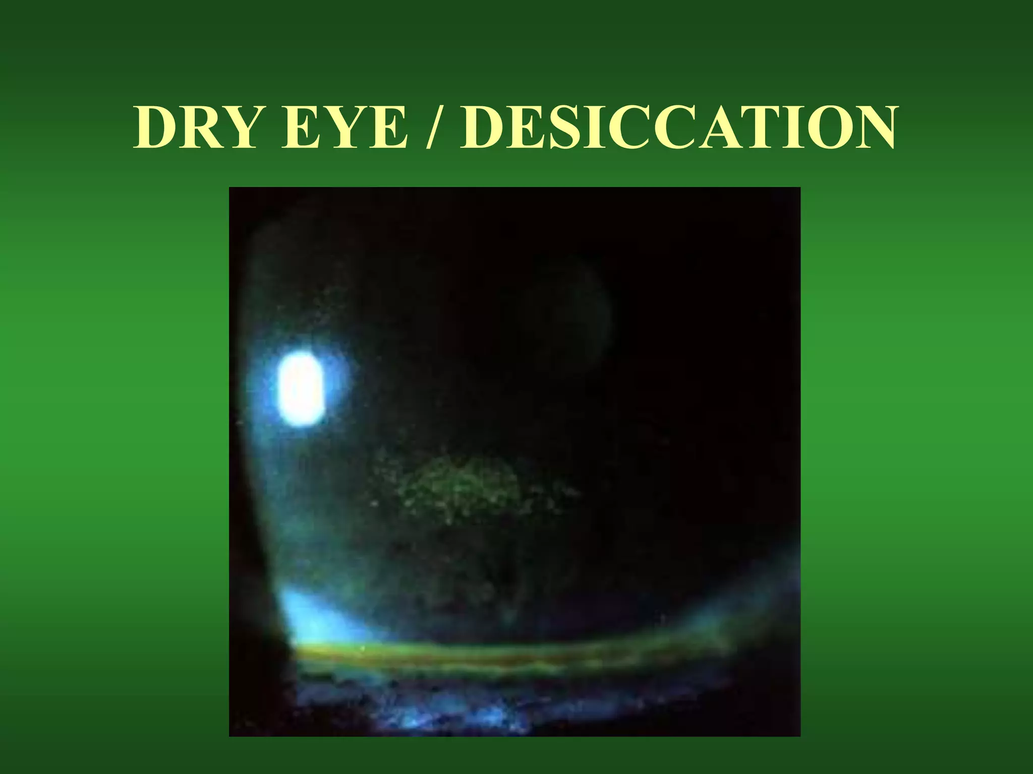 DRY EYE / DESICCATION
 