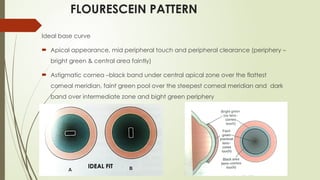 FLOURESCEIN PATTERN
Ideal base curve
 Apical appearance, mid peripheral touch and peripheral clearance (periphery –
bright green & central area faintly)
 Astigmatic cornea –black band under central apical zone over the flattest
corneal meridian, faint green pool over the steepest corneal meridian and dark
band over intermediate zone and bight green periphery
IDEAL FIT
 