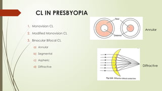 CL IN PRESBYOPIA
1. Monovision CL
2. Modified Monovision CL
3. Binocular Bifocal CL
a) Annular
b) Segmental
c) Aspheric
d) Diffractive
Annular
Diffractive
 