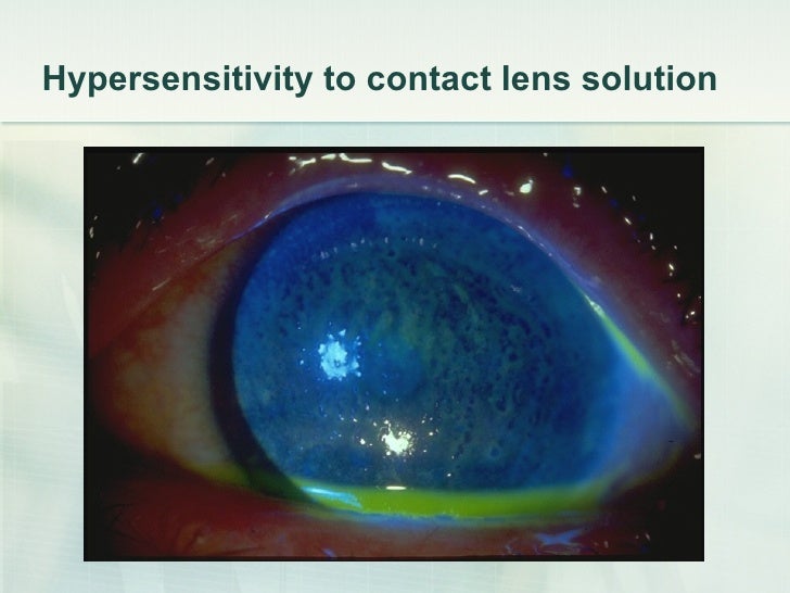 Contact Lenses