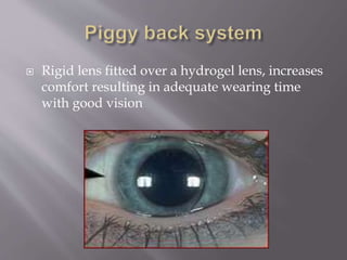  Rigid lens fitted over a hydrogel lens, increases
comfort resulting in adequate wearing time
with good vision
 