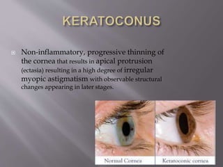  Non-inflammatory, progressive thinning of
the cornea that results in apical protrusion
(ectasia) resulting in a high degree of irregular
myopic astigmatism with observable structural
changes appearing in later stages.
 