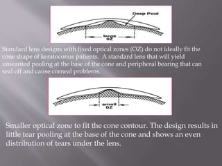Standard lens designs with fixed optical zones (OZ) do not ideally fit the
cone shape of keratoconus patients. A standard lens that will yield
unwanted pooling at the base of the cone and peripheral bearing that can
seal off and cause corneal problems.
Smaller optical zone to fit the cone contour. The design results in
little tear pooling at the base of the cone and shows an even
distribution of tears under the lens.
 