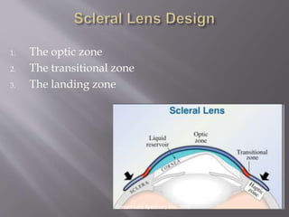 1. The optic zone
2. The transitional zone
3. The landing zone
Contact Lens Spectrum; Dec. 2009
 