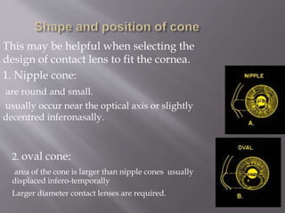 This may be helpful when selecting the
design of contact lens to fit the cornea.
1. Nipple cone:
are round and small.
usually occur near the optical axis or slightly
decentred inferonasally.
2. oval cone:
area of the cone is larger than nipple cones usually
displaced infero-temporally
Larger diameter contact lenses are required.
 