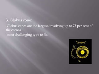 3. Globus cone:
Globus cones are the largest, involving up to 75 per cent of
the cornea
most challenging type to fit.
 