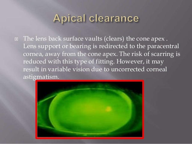Contact lens fitting in keratoconus copy