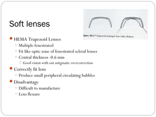 Soft lenses
HEMA Trapezoid Lenses
◦ Multiple fenestrated
◦ Fit like optic zone of fenestrated scleral lenses
◦ Central thickness -0.6 mm
 Good vision with out astigmatic overcorrection
Correctly fit lens
◦ Produce small peripheral circulating bubbles
Disadvantage
◦ Difficult to manufacture
◦ Lens flexure
 