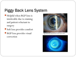 Piggy Back Lens SystemPiggy Back Lens System
Helpful when RGP lens is
intolerable due to staining
and patient reluctant to
surgery
Soft lens provides comfort
RGP lens provides visual
correction
 