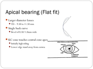 Apical bearing (Flat fit)
Larger diameter lenses
TD – 9.50 to 11.50 mm
Single back curve
Bevel of 0.50/1.0mm wide
KC cone touches central cone apex
Initially high riding
Lower edge stand away from cornea
 