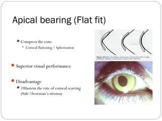 Apical bearing (Flat fit)
Compress the cone
 Corneal flattening / Spherization
Superior visual performance
Disadvantage
??Hastens the rate of corneal scarring
(Sub-bowman’s stroma)
 