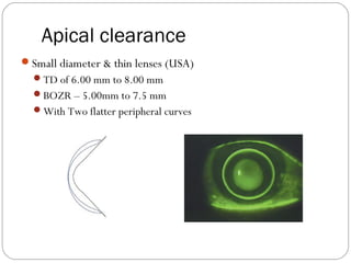 Apical clearance
Small diameter & thin lenses (USA)
TD of 6.00 mm to 8.00 mm
BOZR – 5.00mm to 7.5 mm
With Two flatter peripheral curves
 