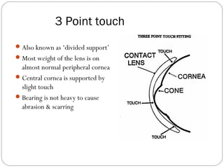 3 Point touch
Also known as ‘divided support’
Most weight of the lens is on
almost normal peripheral cornea
Central cornea is supported by
slight touch
Bearing is not heavy to cause
abrasion & scarring
 