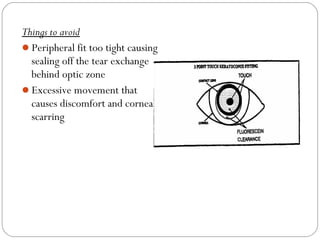 Things to avoid
Peripheral fit too tight causing
sealing off the tear exchange
behind optic zone
Excessive movement that
causes discomfort and corneal
scarring
 