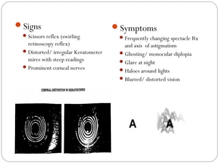 Signs
Scissors reflex (swirling
retinoscopy reflex)
Distorted/ irregular Keratometer
mires with steep readings
Prominent corneal nerves
Symptoms
Frequently changing spectacle Rx
and axis of astigmatism
Ghosting/ monocular diplopia
Glare at night
Haloes around lights
Blurred/ distorted vision
 