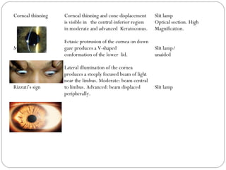 Corneal thinning
Munson’s sign
Rizzuti’s sign
Corneal thinning and cone displacement
is visible in the central-inferior region
in moderate and advanced Keratoconus.
Ectasic protrusion of the cornea on down
gaze produces a V-shaped
conformation of the lower lid.
Lateral illumination of the cornea
produces a steeply focused beam of light
near the limbus. Moderate: beam central
to limbus. Advanced: beam displaced
peripherally.
Slit lamp
Optical section. High
Magnification.
Slit lamp/
unaided
Slit lamp
 