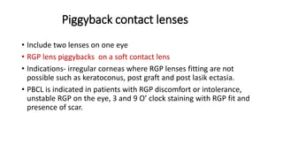Piggyback Rgp Contact lens in keratoconus 2 | PPT