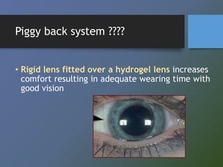 Piggyback Rgp Contact lens options in keratoconus hira | PPTX