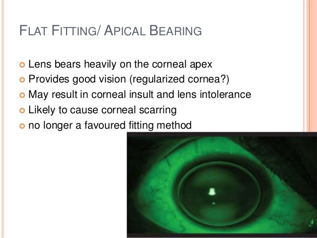 A Guide To Billing For Medically Necessary Contact Lenses Eyes On A Guide To Billing For Medically Necessary Contact Lenses Eyes On
