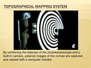 By combining the features of the photokeratoscope and a
built-in camera, polaroid images of the cornea are captured
and viewed with a computer monitor.
 