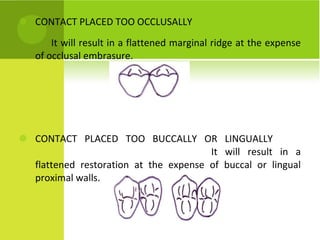 CONTACT PLACED TOO OCCLUSALLY It will result in a flattened marginal ridge at the expense of occlusal embrasure. CONTACT PLACED TOO BUCCALLY OR LINGUALLY It will result in a flattened restoration at the expense of buccal or lingual proximal walls. 