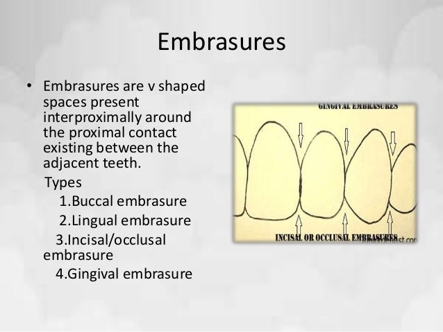 3 types of gingival embrasures