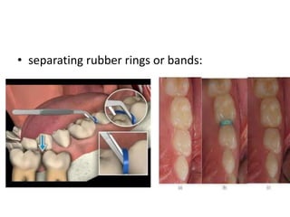 • separating rubber rings or bands:
 