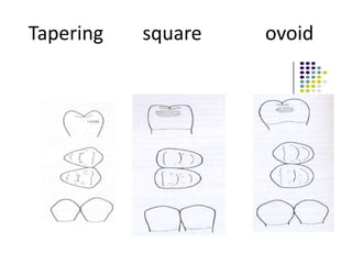 Tapering square ovoid
 