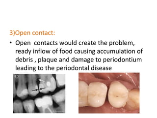 3)Open contact:
• Open contacts would create the problem,
ready inflow of food causing accumulation of
debris , plaque and damage to periodontium
leading to the periodontal disease
 
