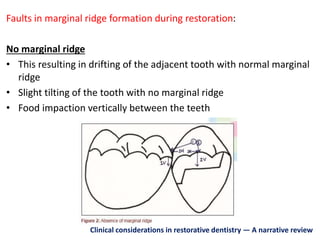 Faults in marginal ridge formation during restoration:
No marginal ridge
• This resulting in drifting of the adjacent tooth with normal marginal
ridge
• Slight tilting of the tooth with no marginal ridge
• Food impaction vertically between the teeth
Clinical considerations in restorative dentistry — A narrative review
 
