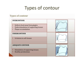 Types of contour
 