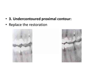 • 3. Undercontoured proximal contour:
• Replace the restoration
 