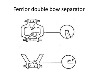Ferrior double bow separator
 